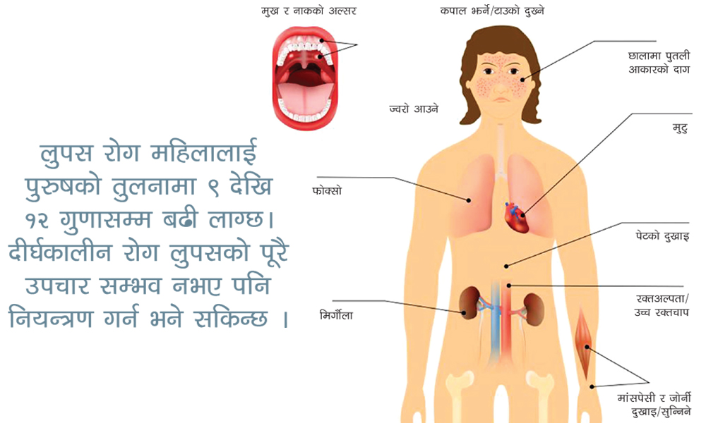 पुरुषको तुलनामा महिलालाई १२ गुणासम्म बढी सताउने रोग लुपसका बारेमा जान्नुहोस्…………